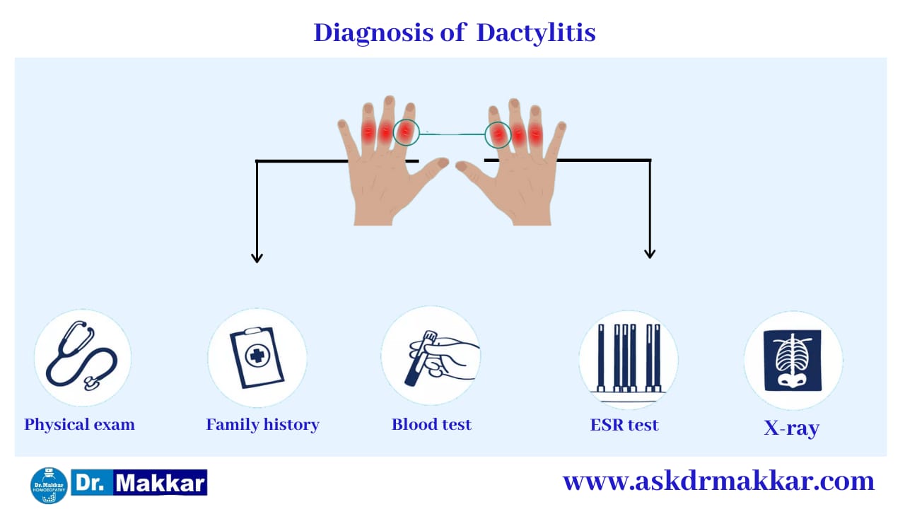 Dactylitis Sausage Fingers Digit Swelling Of Fingers And Toes